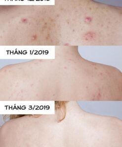 Xa Phong Tri Mun Lung Back Soap7